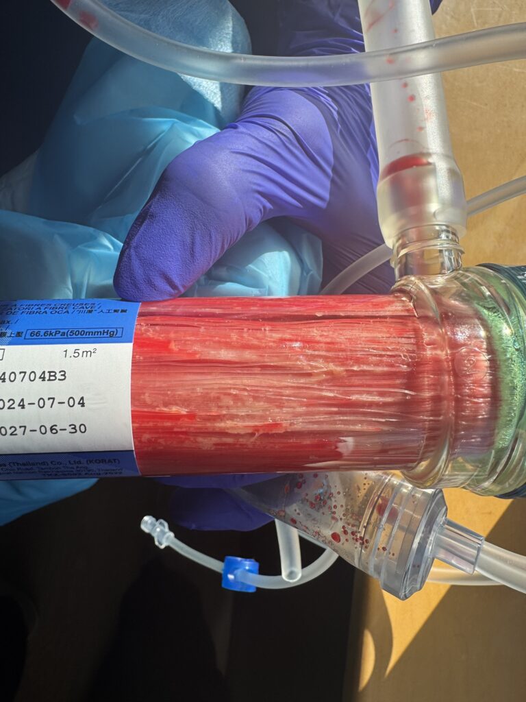 photo of used eboo dialyzer with particles in filter